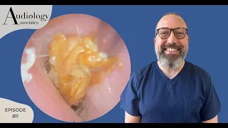 THE EAR WAX EVEN THE CONSULTANT COULDN'T REMOVE- EP811