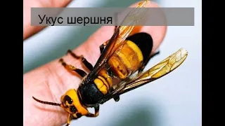 Укус шершня