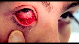 REALLY BAD PINK EYE with Discharge & Fever | Dr. Paul