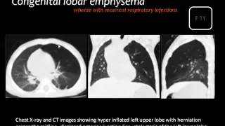 Imaging of Pediatirc chest IV   Prof  Dr  Mamdouh Mahfouz In Arabic