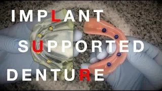 Implant Supported Denture