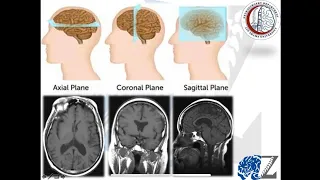 Normal MRI Brain (Radiological Anatomy)