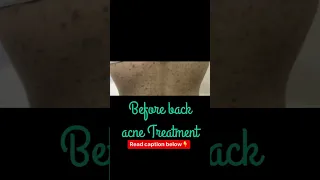 Doctor's Secret Back Acne Cure Revealed: #DrAshimaGoel #ParisaSkinClinic #Chandigarh #YouTubeShorts