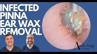 INFECTED PINNA EAR WAX REMOVAL - EP880