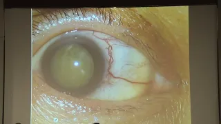 AIOC2022-IC531-Ocular Malignancies- Never Miss to DetectDr Fairooz PM