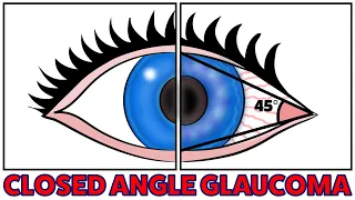 The simple 3 minute method to fix Closed Angle Glaucoma Naturally!