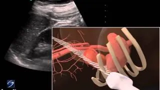 3D How To: Left Kidney Ultrasound - SonoSite Ultrasound