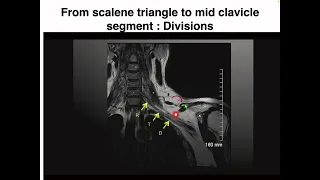 MRI Anatomy of Brachial Plexus