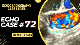 ECHO CASE 72 - Echocardiography for Beginners - Echo spot diagnosis Series - Cardiology