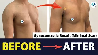 Gynecomastia Surgery 3 Weeks Results | Gland Removal Surgery | Team of Plastic Surgeon