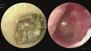 Difficult Stony Hard Ear Wax Removal Ep05