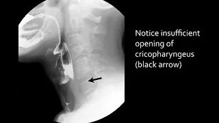 Swallowing disorders - Aspiration due to stasis (2)