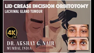 Lateral Orbitotomy for Lacrimal Gland Tumour - Lid Crease Approach: Dr. Akshay Nair, Mumbai, India