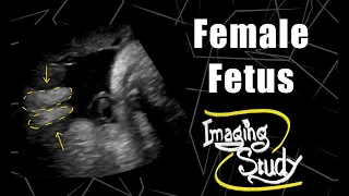 Female Fetus - Its a Girl || Ultrasound || Case 59