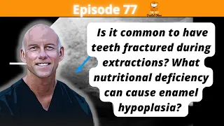 Ep 77 - Is it common to have teeth fractured during extractions?