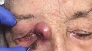 Draining an Abscess