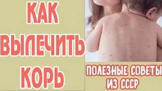 Как лечить корь у детей в домашних условиях. Корь симптомы. Лечение кори у ребенка. Советы из СССР