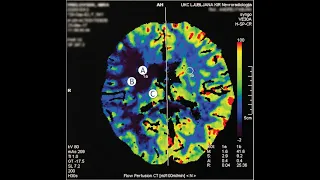 MANAGEMENT OF ACUTE ISCHEMIC STROKE: PART 2/2 -MECHANICAL THROMBECTOMY