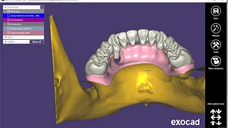 Making a "surgical guide" that double as the hybrid restoration