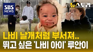 희귀하지만 평범하고 싶은 희귀질환자의 아픔 (뉴스토리) / SBS