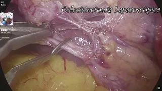 Colecistectomía Laparoscópica (COLELAP) - DR.APARI 👨‍⚕️