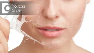 Medium depth peels for acne scar removal & its effectiveness - Dr. Rajdeep Mysore