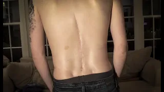 My Scoliosis Story - Spinal Fusion Surgery