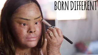 My Skin Condition Has No Cure | BORN DIFFERENT