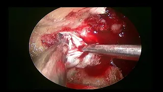 PTERYGOPALATINE FOSSA AND MUCOR