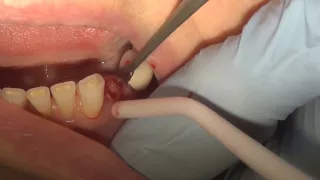 How to pull a broken tooth
