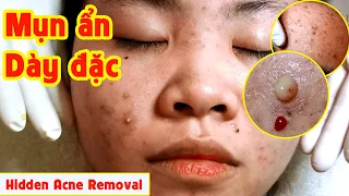 Điều trị mụn hiệu quả TPHCM | Hiền Vân spa| So much Hidden Acne |Acne removal | Đỗ Thu Hiền | 617
