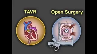 Aortic-Valve Replacement