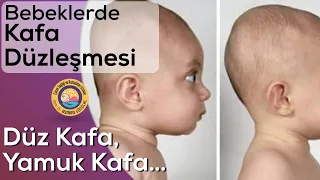 Bebeklerde Kafa Düzleşmesi ve Yamukluk (Plagiosefali)