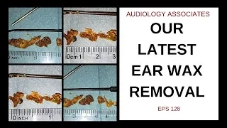 OUR LATEST EAR WAX REMOVAL - EP 128