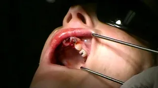 Lateral Upper Anterior Tooth Extraction, broken at gumline, curved root
