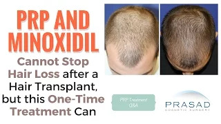 PRP or Minoxidil Cannot Stop Hair Loss After a Hair Transplant, and Better Hair Loss Mangement