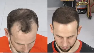Мотокроссмен Геннадий Зырин о пересадке волос в Real Trans Hair
