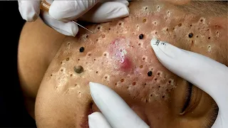 Enjoy Every Day With The Best Video Loan Nguyen Acne  #103