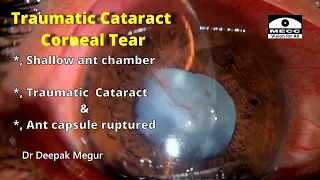 Traumatic Cataract with a sealed Corneal Tear - Dr Deepak Megur