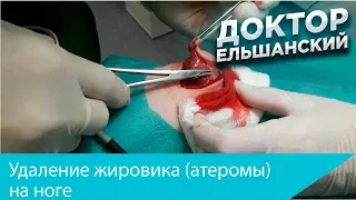 Удаление жировика (атеромы) на ноге