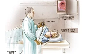 ЭГДС Рак Пищевода и Желудка (et esophageal cancer stomachi)