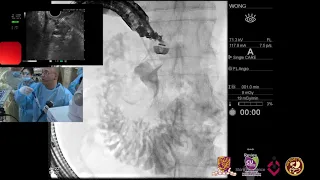 Case 34_Endoscopic ultrasound rendezvous endoscopic retrograde cholangiopancreatography