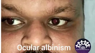 Nystagmus + Ocular Albinism