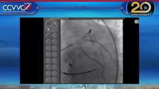 Live Case 1 - Left Main Bifurcation Lesion PCI using 2 Stent Strategy and IVUS Device - CCVVC 2017