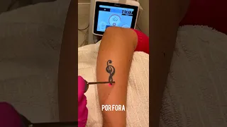 REMOÇÃO DE TATUAGEM