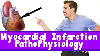 Myocardial Infarction pathophysiology