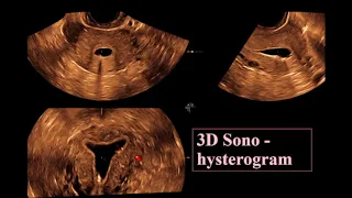 The Endometrium ultrasound