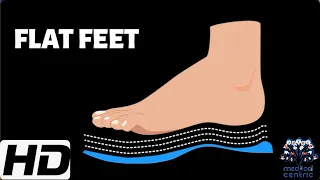 FLAT FEET: Everything You Need To Know