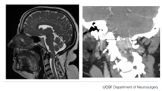 Far lateral approach for resection of a foramen magnum meningioma