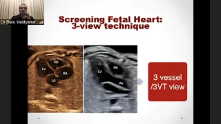 GE Webinar: An approach to diagnosis of common congenital heart defects in fetus using 2D imaging